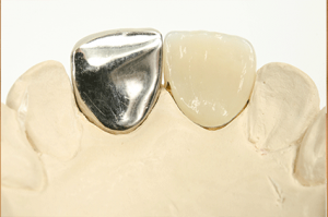銀歯取れる 銀歯の下の虫歯