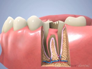 根管治療（臼歯） 2
